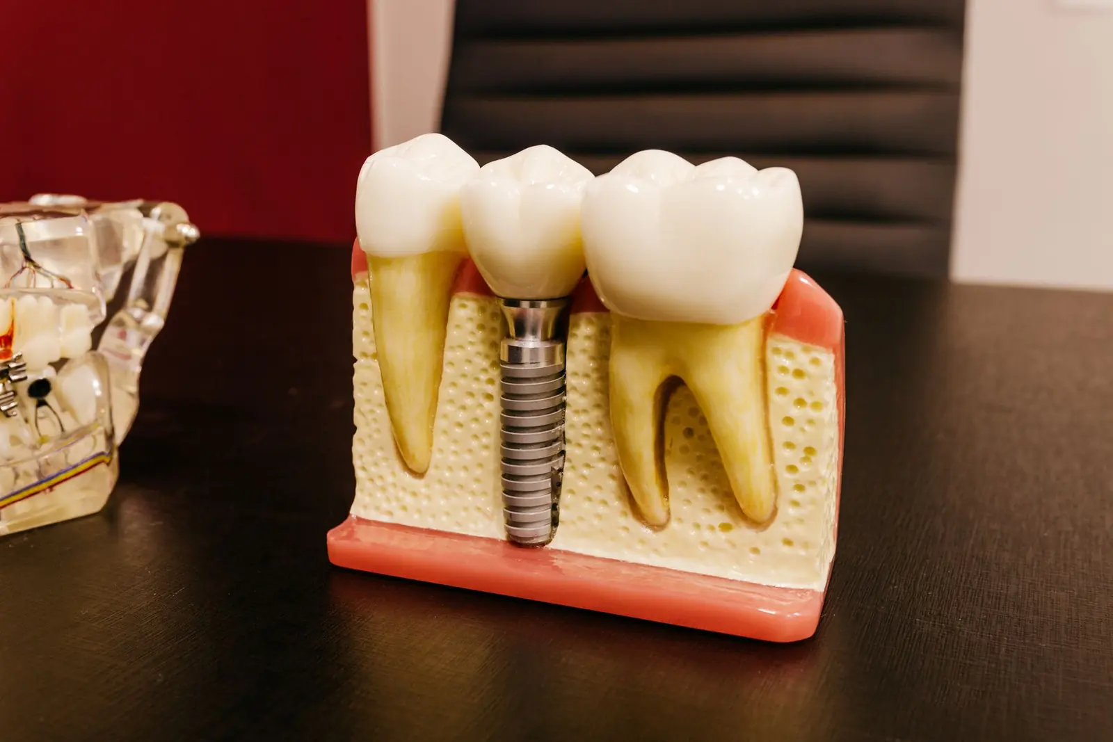 Modelo odontológico mostrando um implante dentário entre dois dentes naturais